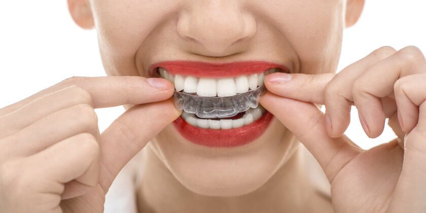 歯ぎしり用のマウスピース