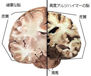 アルツハイマーの脳