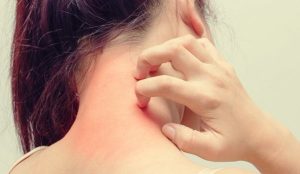 アトピー性湿疹とストレスの関係