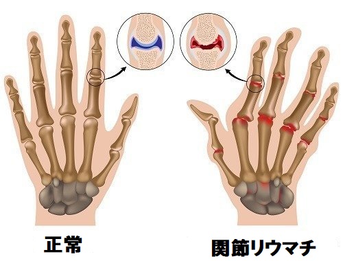関節リウマチ