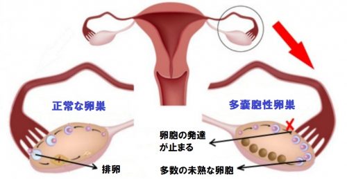 多嚢胞卵巣症候群