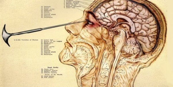 アイスピック・ロボトミー