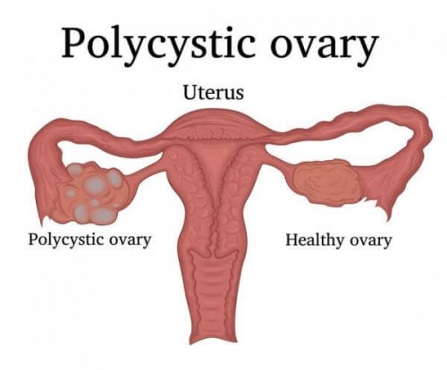 多嚢胞性卵巣症候群について学びましょう