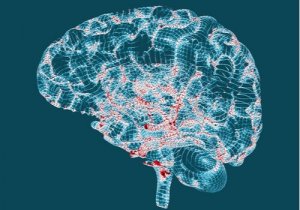 ハンチントン病 − その特徴と兆候