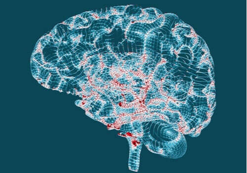 ハンチントン病 − その特徴と兆候