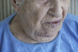 顔面麻痺:その原因と治療について