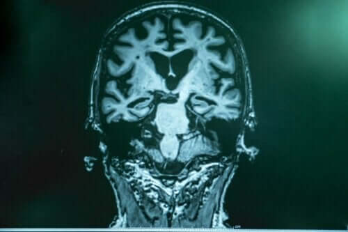 アルツハイマー病患者のための脳波刺激法