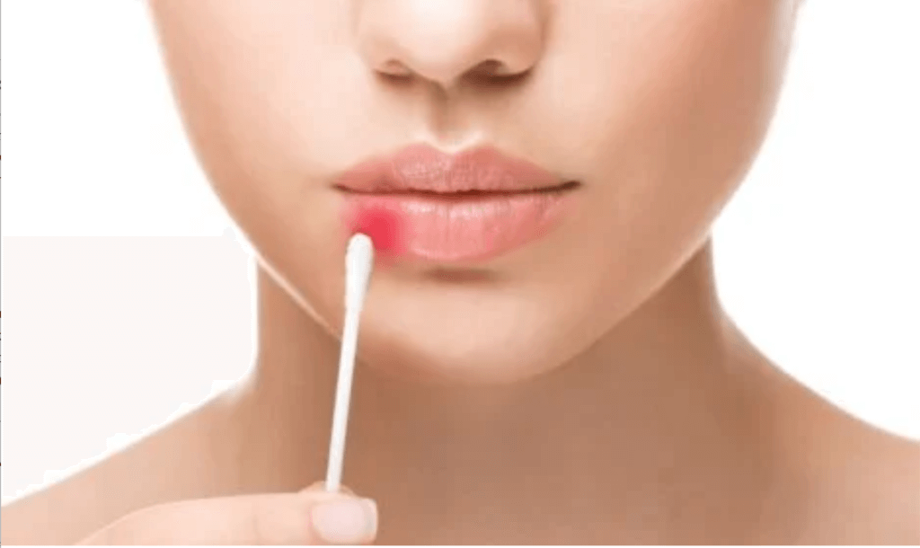 口唇ヘルペス ストレス 関係性